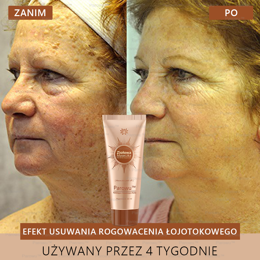 Parowu™ Wybielająca i Rozjaśniająca Maska - Naturalne składniki trwale usuwają plamy, piegi i przebarwienia